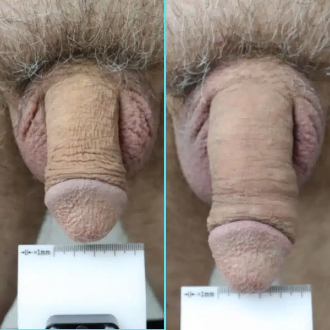Side-by-side before and after photo of non-surgical penile girth enhancement with 15 syringes of Bellafill® (PMMA), showing the increased flaccid penile length along with enhanced penile girth.