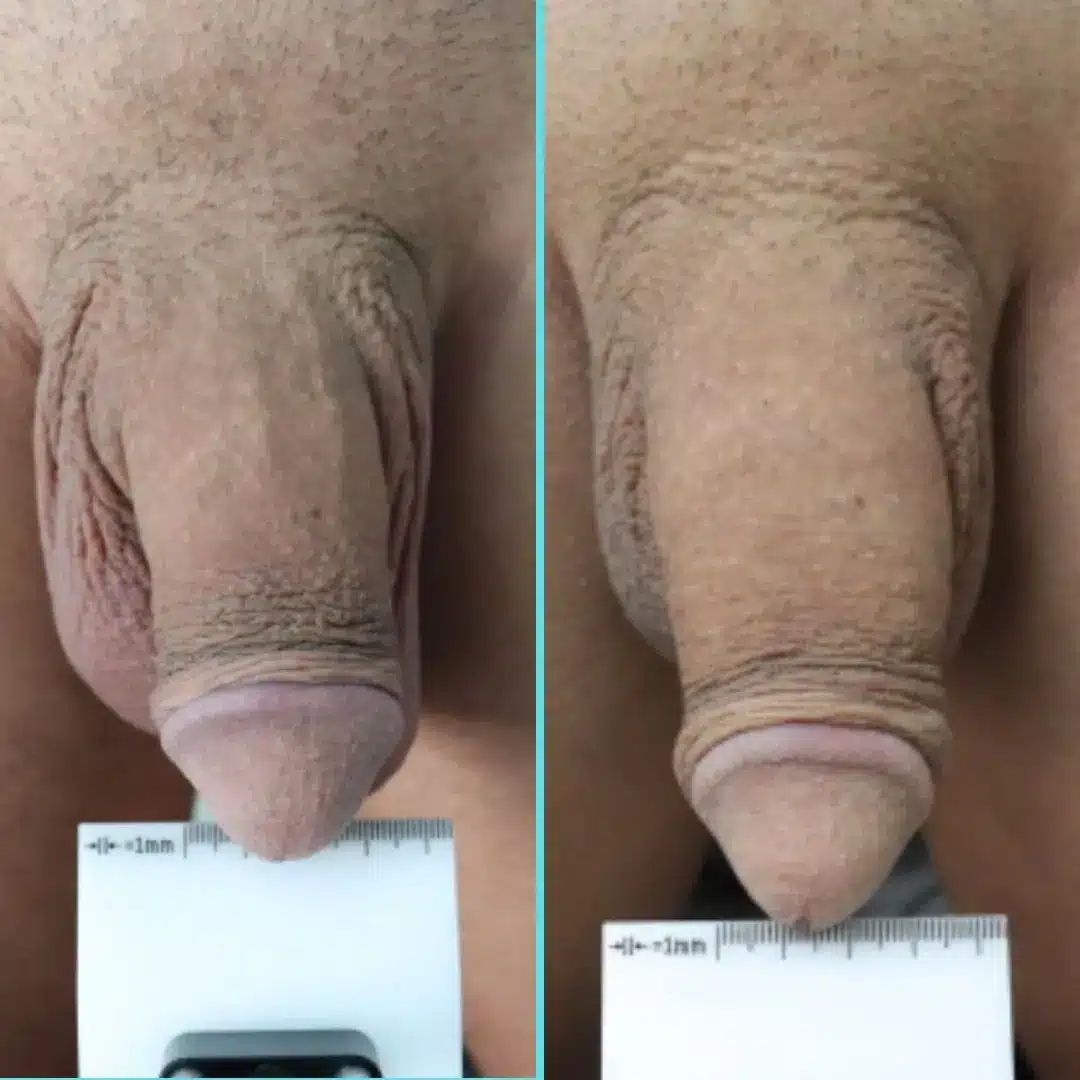 Side-by-side comparison before and after non-surgical penile girth enhancement using 23 syringes of Voluma (HA) and 3 syringes of Bellafill (PMMA), highlighting increased penile weight, a fuller flaccid hang, and enhanced penile girth.