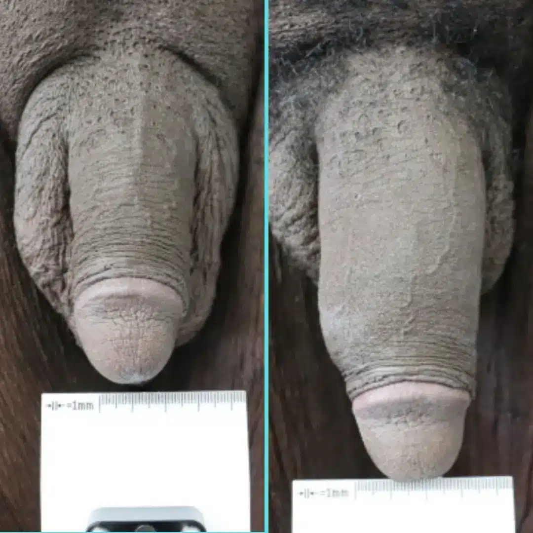 Side-by-side comparison before and after non-surgical penile girth enhancement with 16 syringes of Voluma (HA), highlighting increased flaccid (soft) length and penile girth.
