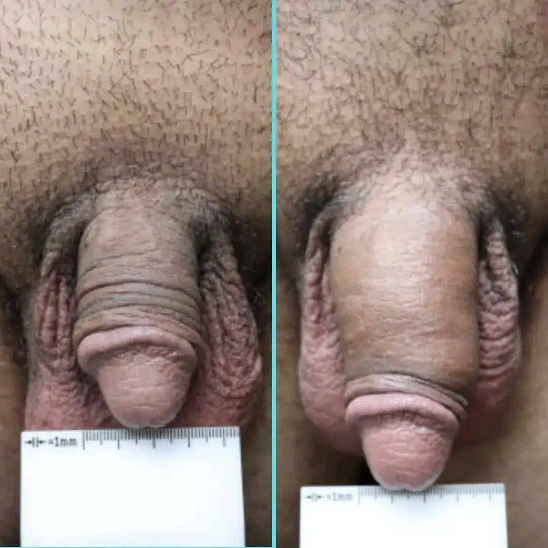 Side-by-side comparison before and after non-surgical penile girth enhancement with 10 syringes of Voluma® (HA), highlighting enhanced penile girth and an internal sleeve effect that helps support a fuller flaccid appearance.